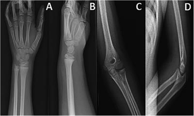 Case Report: Atypical acute compartment syndrome of the forearm in a child following minor trauma with consecutive osteomyelitis